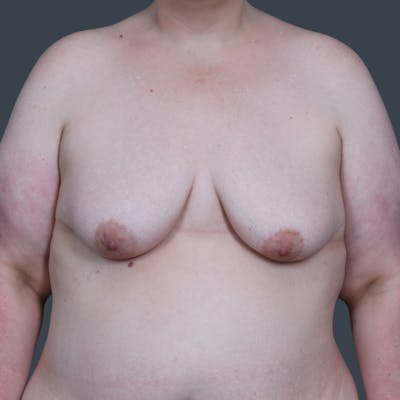 Breast Reduction Before & After Gallery - Patient 568847 - Image 1