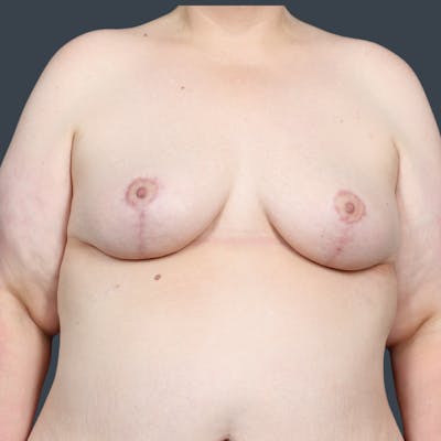 Breast Reduction Before & After Gallery - Patient 568847 - Image 2