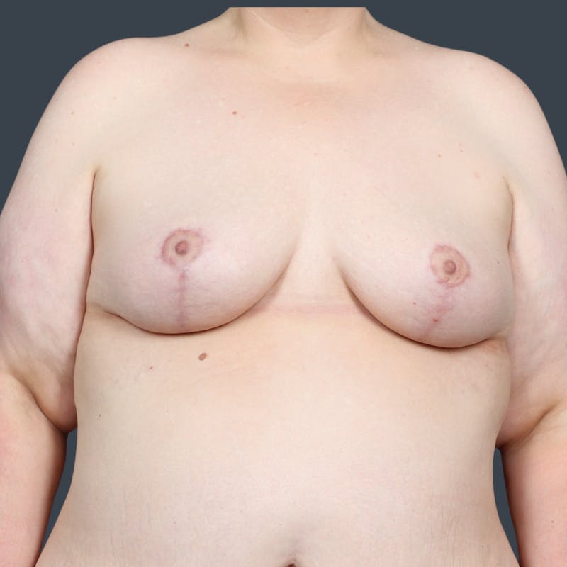 Breast Reduction Before & After Gallery - Patient 568847 - Image 2