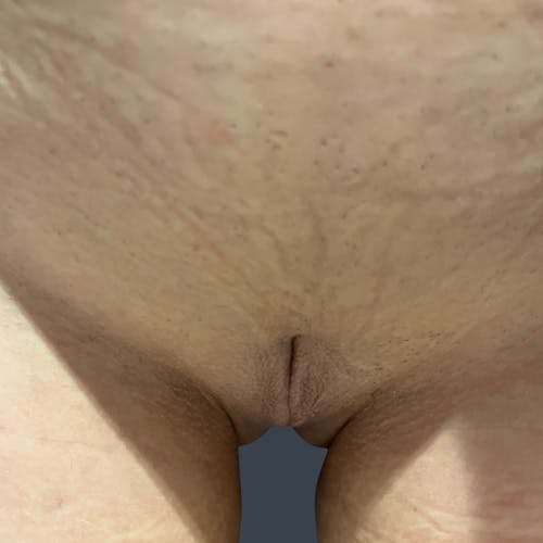 After procedure image for Labiaplasty