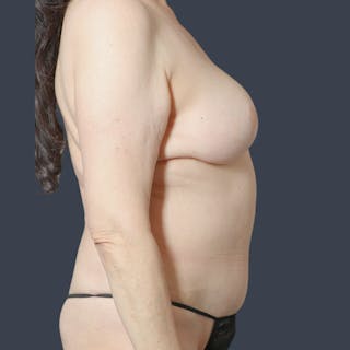 DIEP Flap Before & After Gallery - Patient 111446 - Image 6