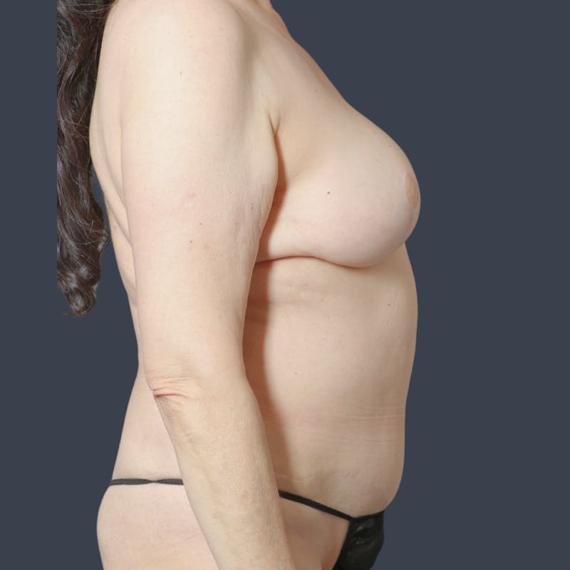 DIEP Flap Before & After Gallery - Patient 111446 - Image 6