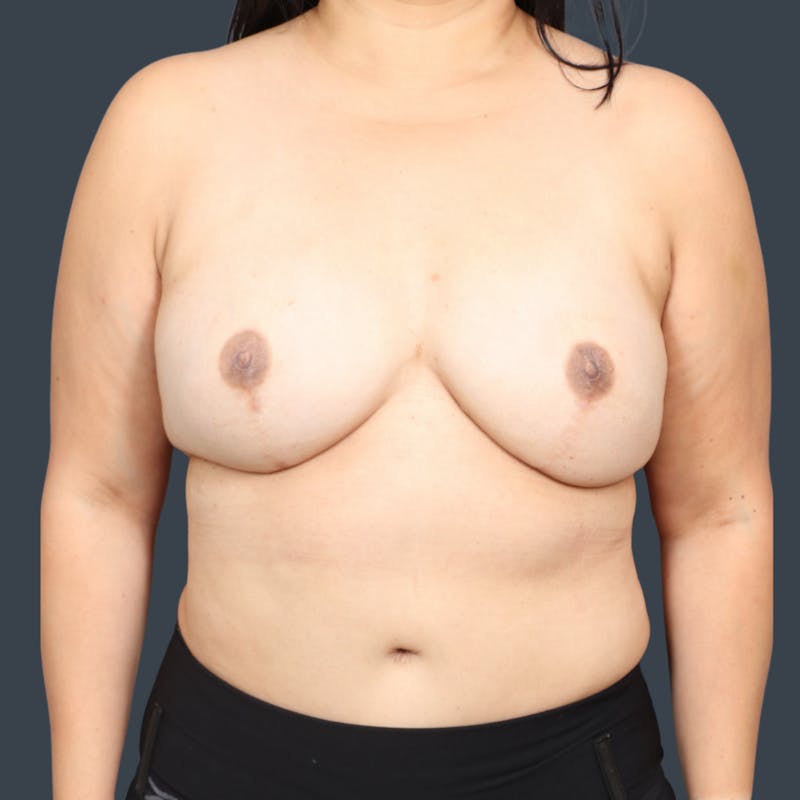 DIEP Flap Before & After Gallery - Patient 540115 - Image 2