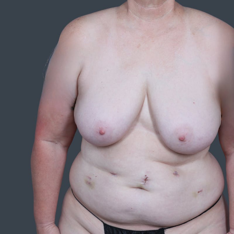 DIEP Flap Before & After Gallery - Patient 249595 - Image 1