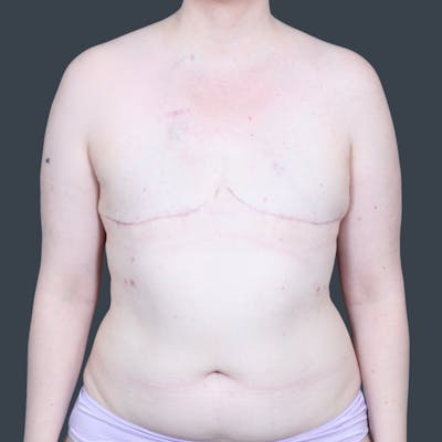 DIEP Flap Before & After Gallery - Patient 217322 - Image 1