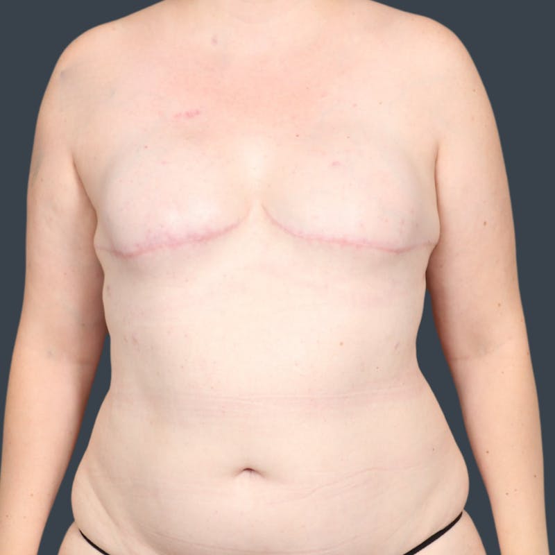 DIEP Flap Before & After Gallery - Patient 217322 - Image 2