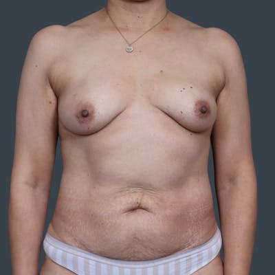 DIEP Flap Before & After Gallery - Patient 375496 - Image 1