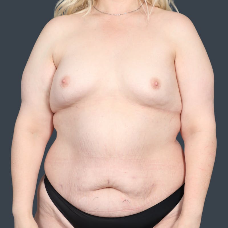 DIEP Flap Before & After Gallery - Patient 203178 - Image 1