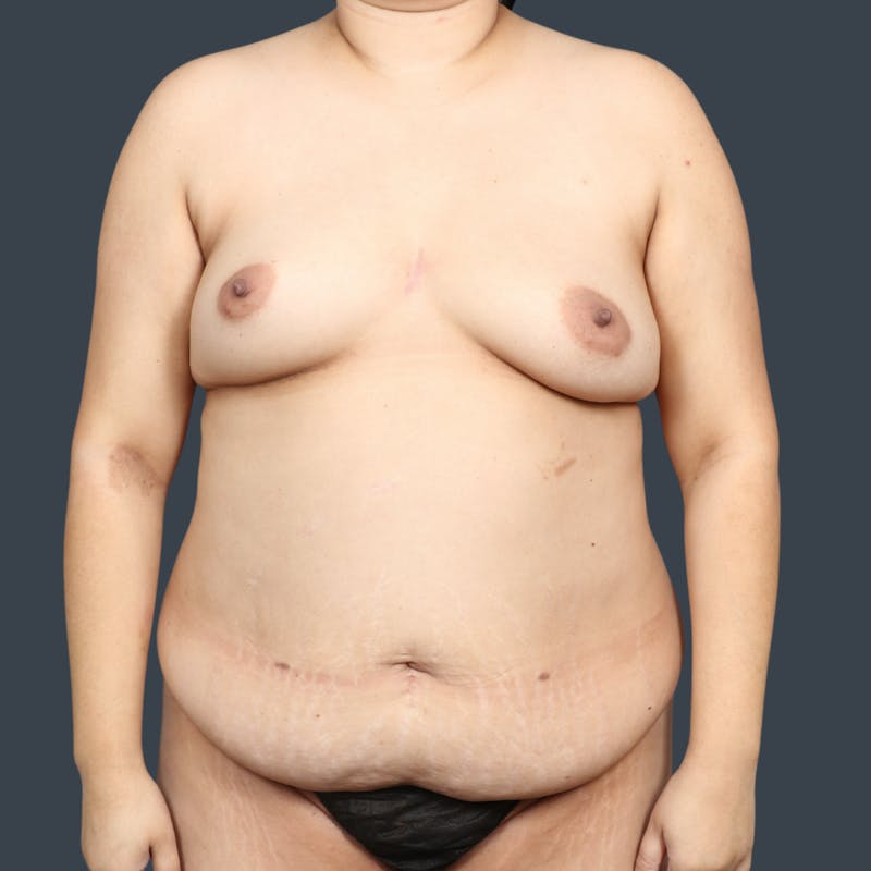 DIEP Flap Before & After Gallery - Patient 346841 - Image 1