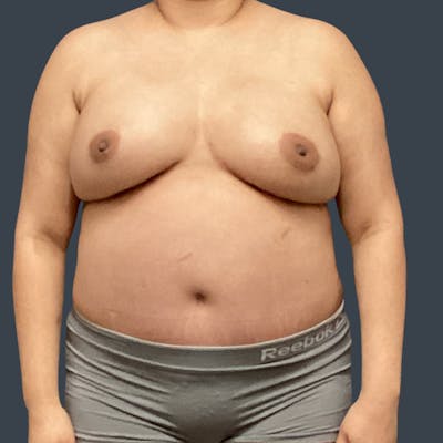 DIEP Flap Before & After Gallery - Patient 346841 - Image 2