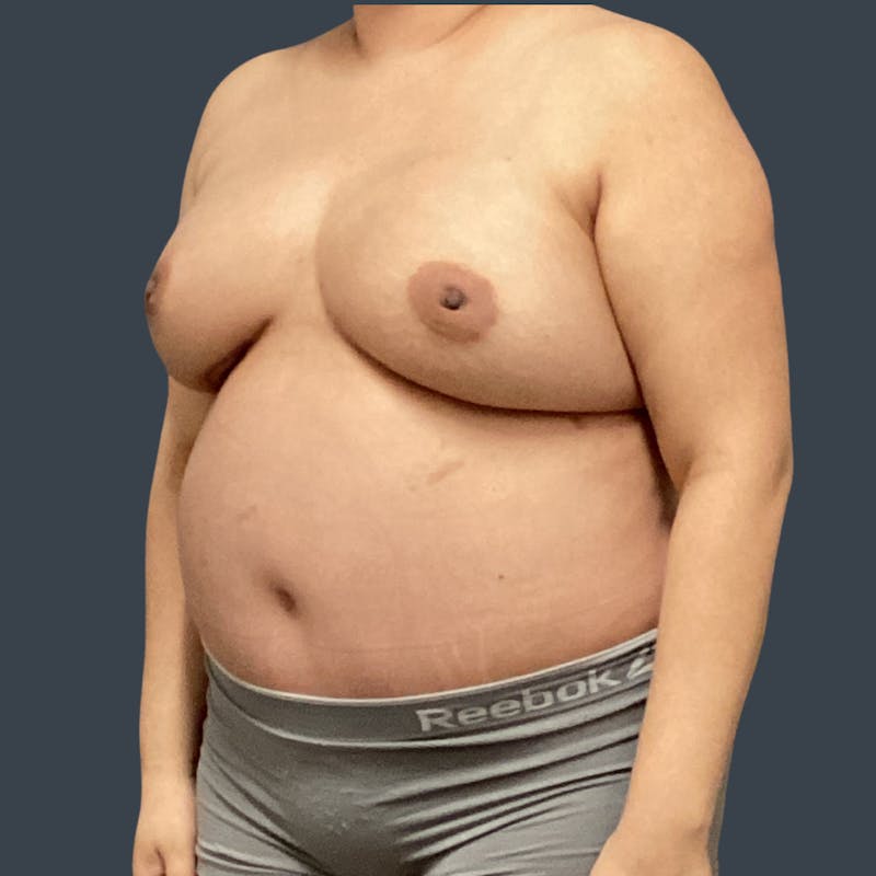 DIEP Flap Before & After Gallery - Patient 346841 - Image 4