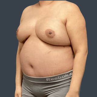 DIEP Flap Before & After Gallery - Patient 346841 - Image 4