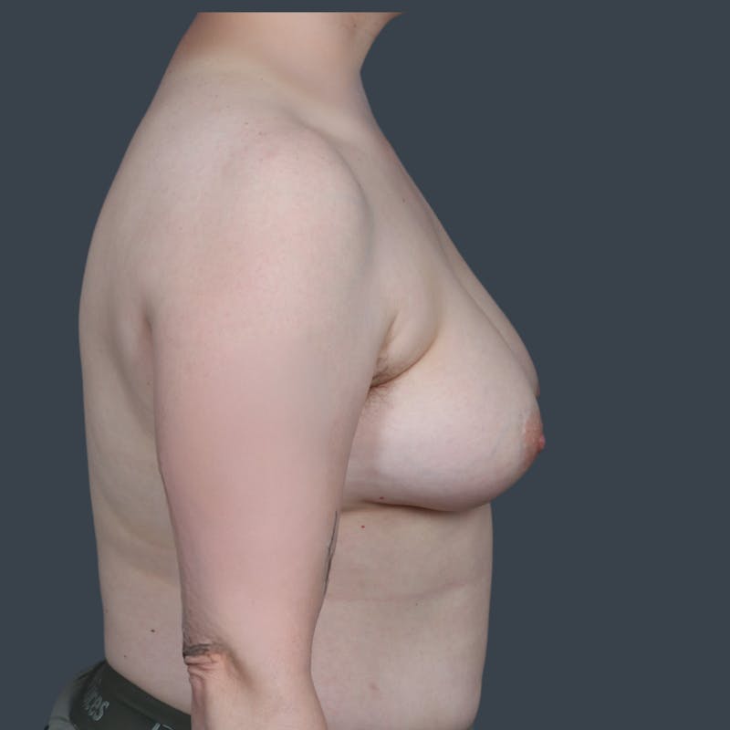 Top Surgery Before & After Gallery - Patient 124653 - Image 3