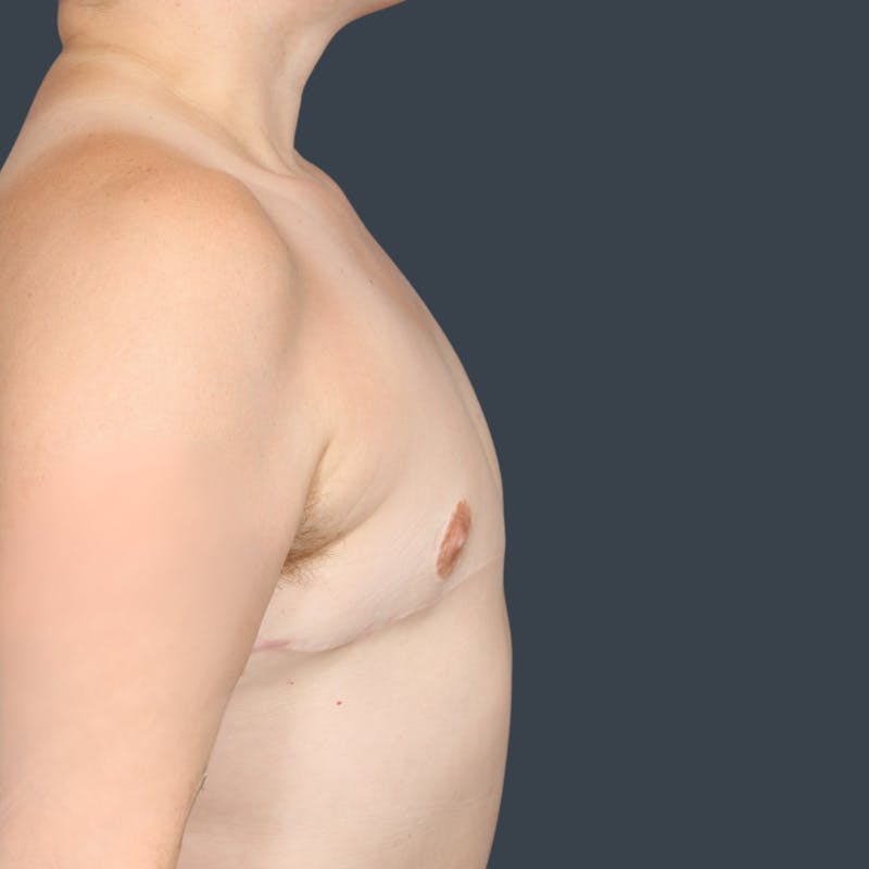 Top Surgery Before & After Gallery - Patient 124653 - Image 4