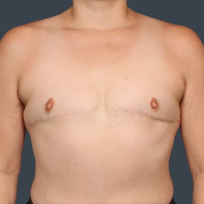 Top Surgery Before & After Gallery - Patient 124653 - Image 2