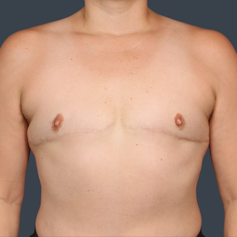 Top Surgery Before & After Gallery - Patient 124653 - Image 2