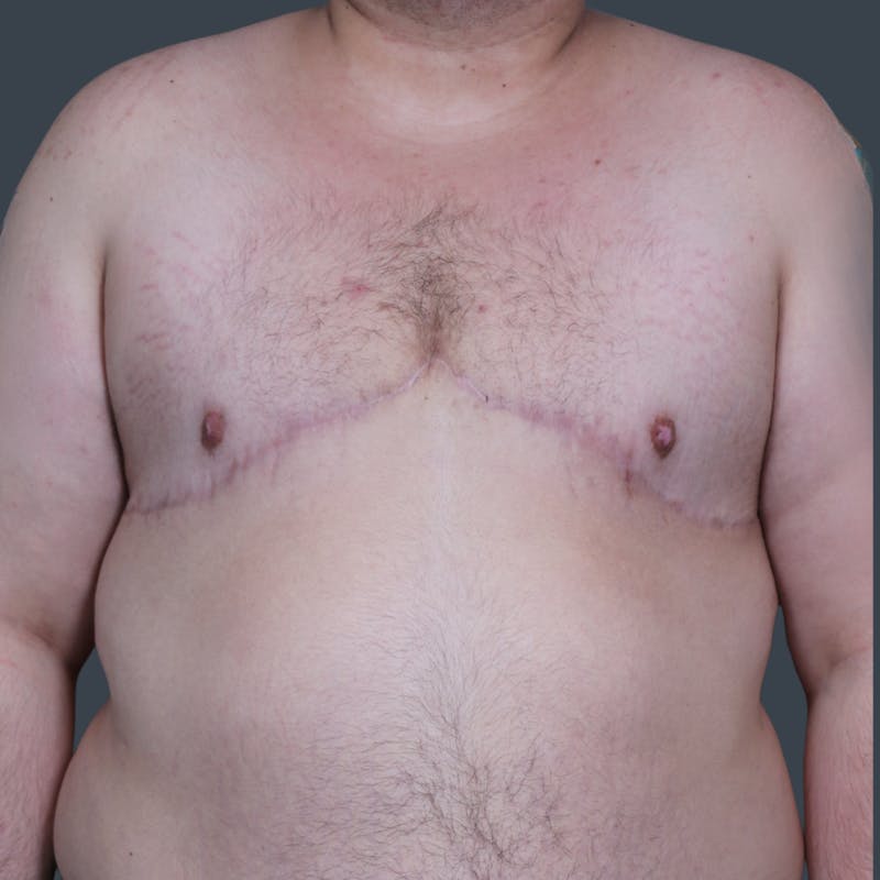 Top Surgery Before & After Gallery - Patient 269946 - Image 2