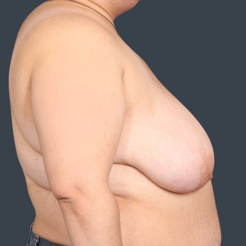 Top Surgery Before & After Gallery - Patient 269946 - Image 3