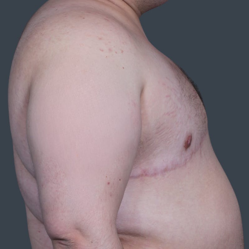 Top Surgery Before & After Gallery - Patient 269946 - Image 4