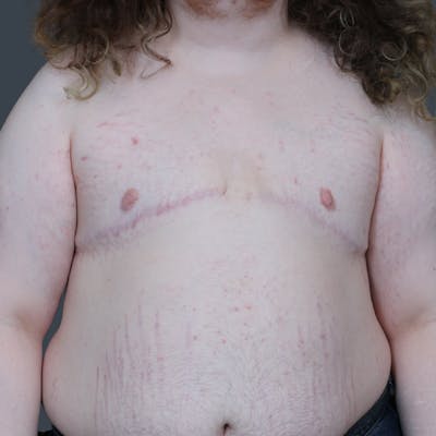 Top Surgery Before & After Gallery - Patient 164883 - Image 2