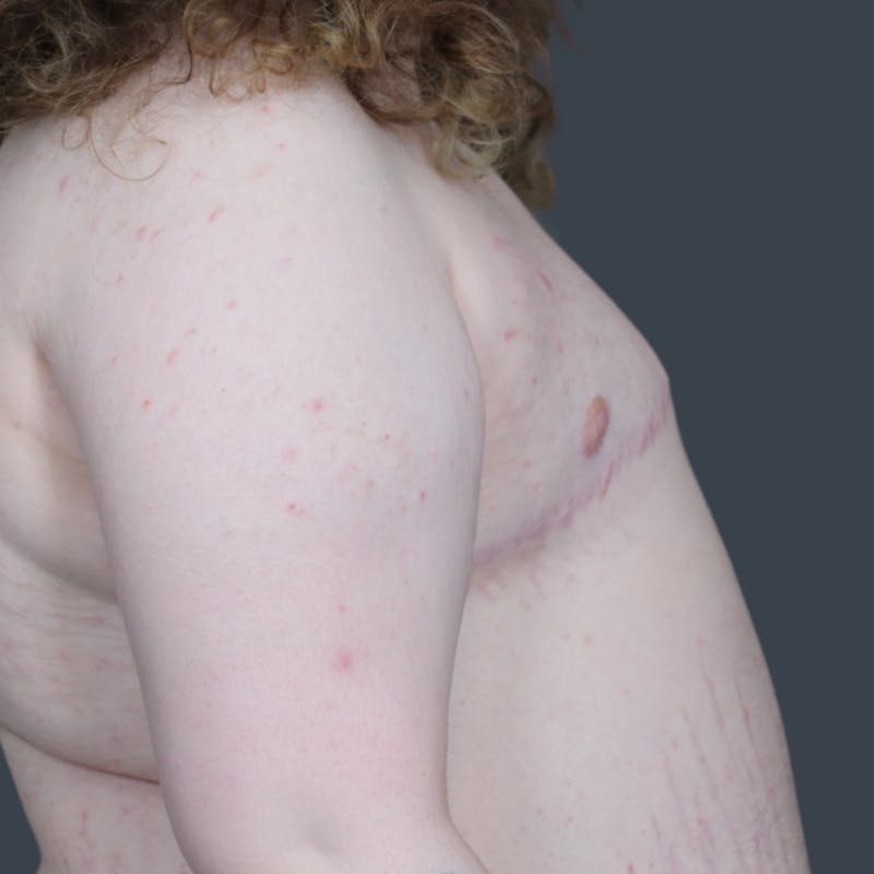Top Surgery Before & After Gallery - Patient 164883 - Image 4