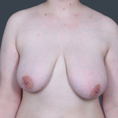 Top Surgery Before & After Gallery - Patient 393970 - Image 1
