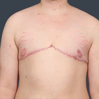 Top Surgery Before & After Gallery - Patient 393970 - Image 2