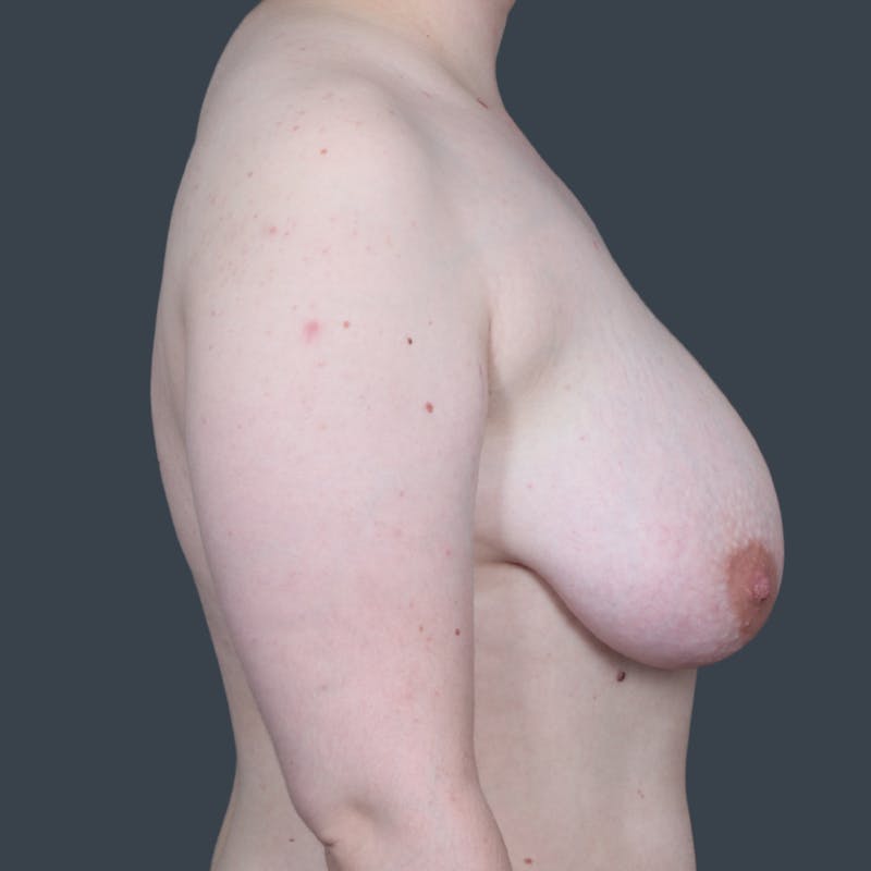 Top Surgery Before & After Gallery - Patient 393970 - Image 3