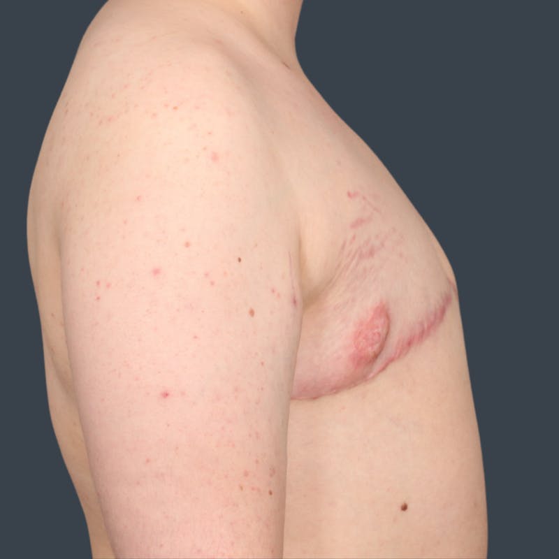 Top Surgery Before & After Gallery - Patient 393970 - Image 4