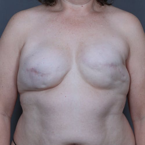Before procedure image for Breast Reconstruction Revision