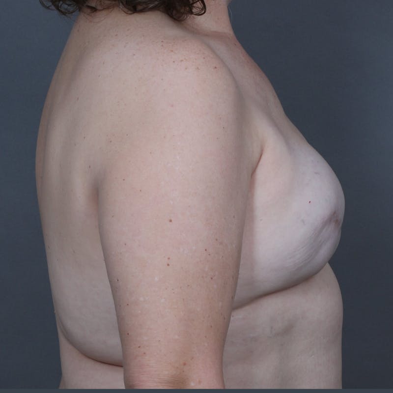 Breast Reconstruction Revision Before & After Gallery - Patient 236153 - Image 3