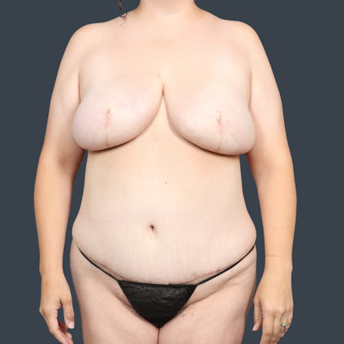 After procedure image for Breast Reconstruction Revision