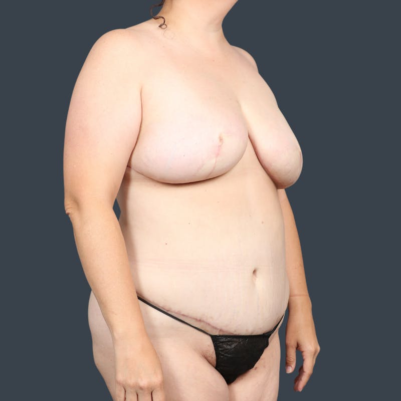 Breast Reconstruction Revision Before & After Gallery - Patient 369716 - Image 4