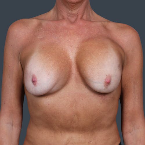 Before procedure image for Breast Reconstruction Revision