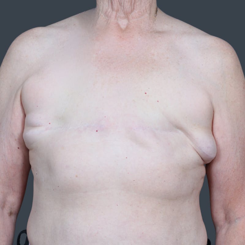 Breast Reconstruction Revision Before & After Gallery - Patient 958781 - Image 1
