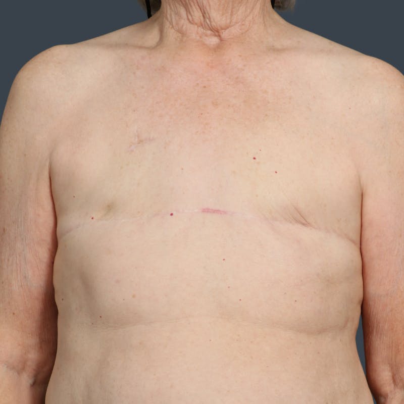 Breast Reconstruction Revision Before & After Gallery - Patient 958781 - Image 2