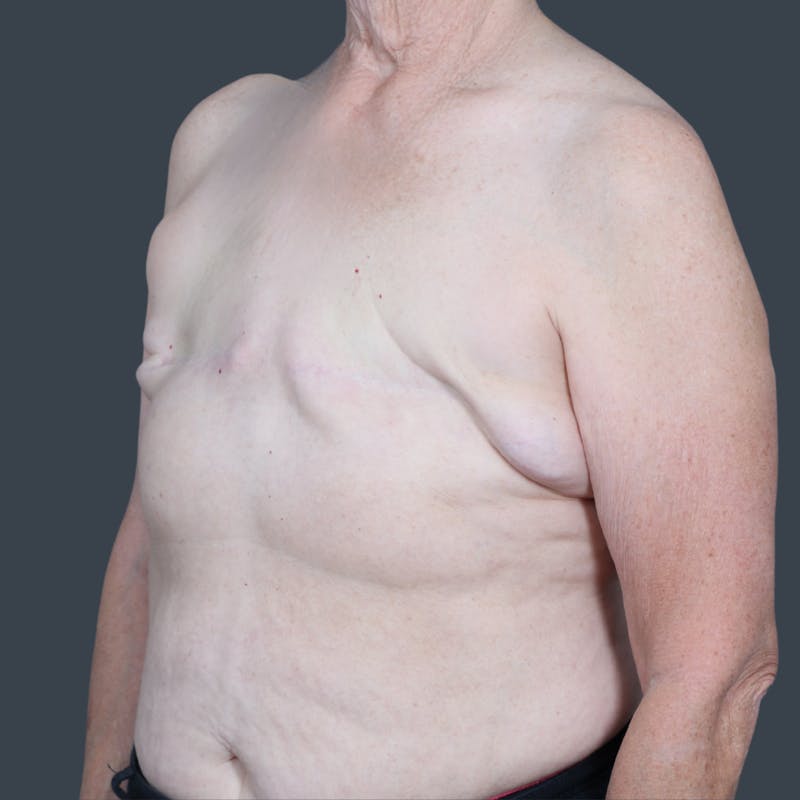 Breast Reconstruction Revision Before & After Gallery - Patient 958781 - Image 3