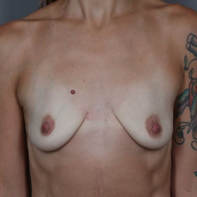 Implant Breast Reconstruction Before & After Gallery - Patient 657251 - Image 1