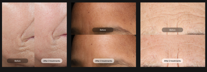 D.E.J BioStim clinical results