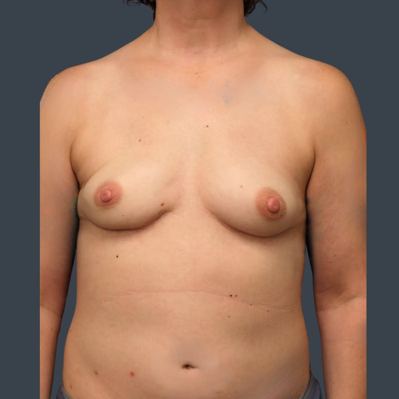 Immediate PAP Flap Before & After Gallery - Patient 233062 - Image 2