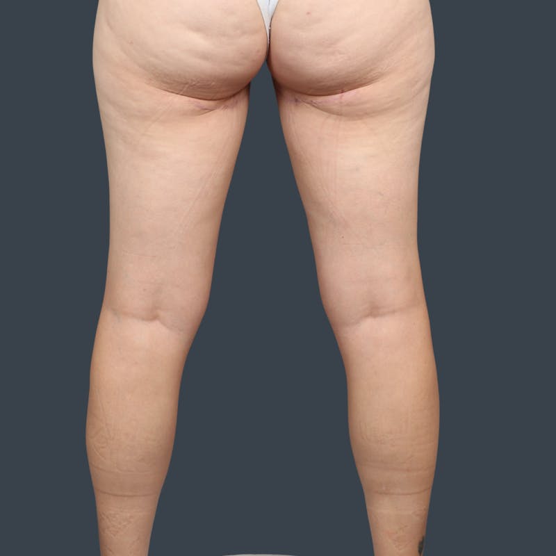 Immediate PAP Flap Before & After Gallery - Patient 233062 - Image 4