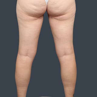 Immediate PAP Flap Before & After Gallery - Patient 233062 - Image 4