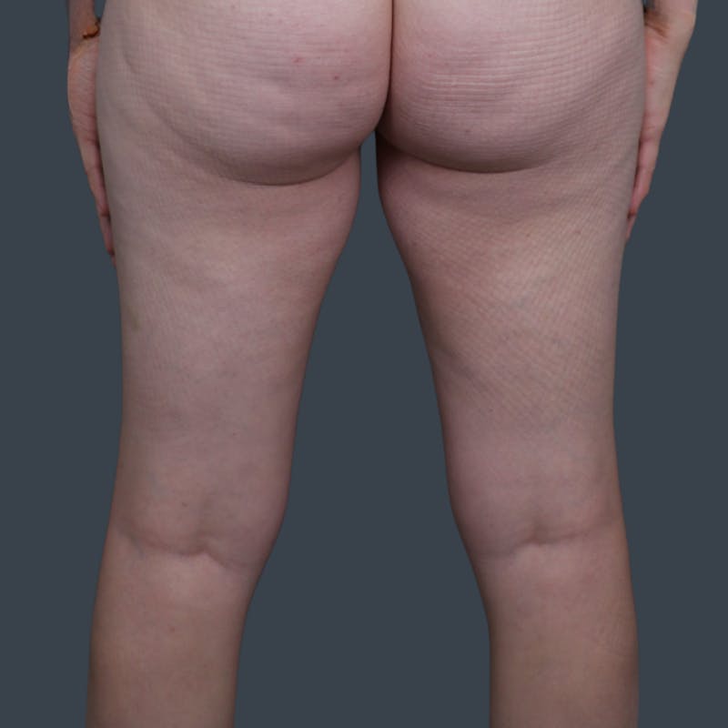 Immediate PAP Flap Before & After Gallery - Patient 233062 - Image 3