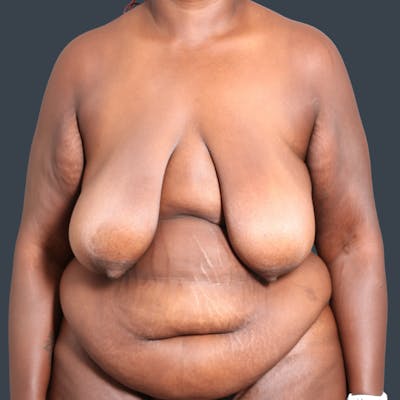 Mommy Makeover Before & After Gallery - Patient 190159 - Image 1