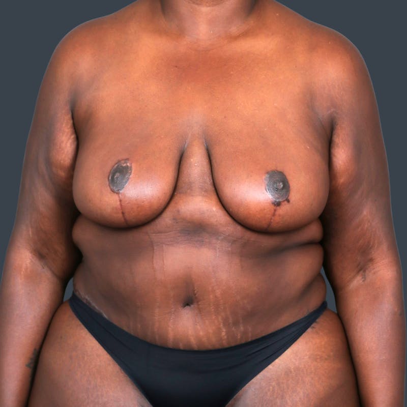 Mommy Makeover Before & After Gallery - Patient 190159 - Image 2
