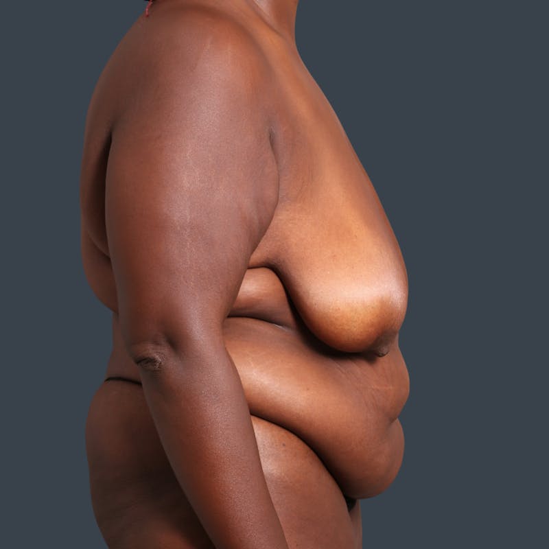 Mommy Makeover Before & After Gallery - Patient 190159 - Image 3