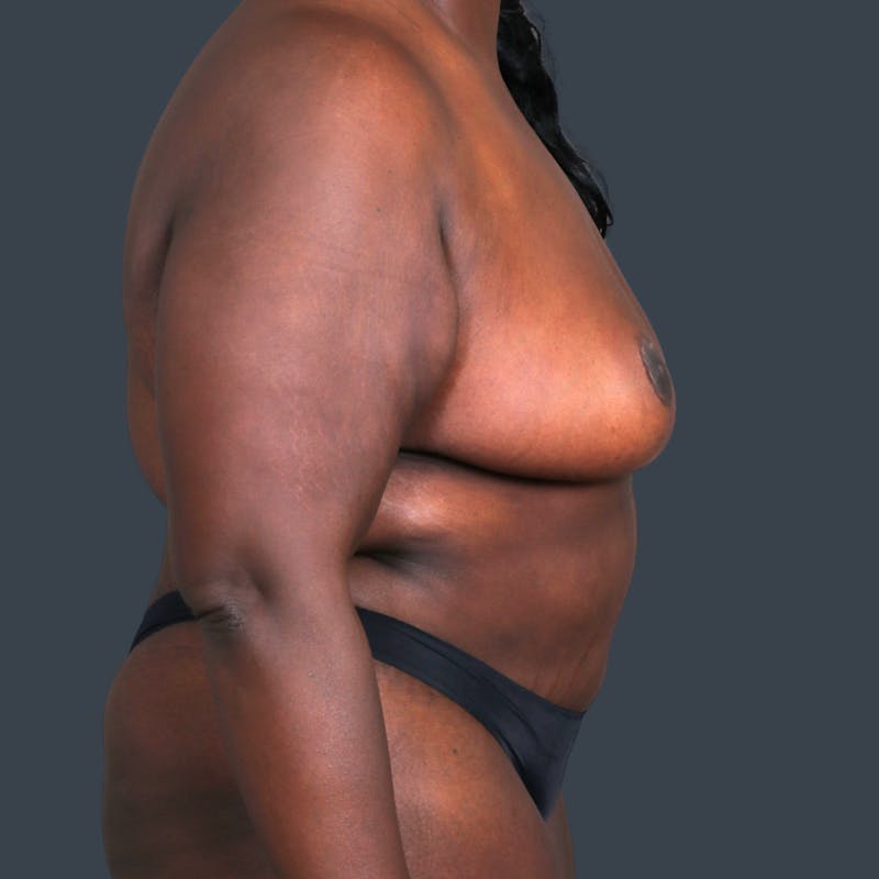 Mommy Makeover Before & After Gallery - Patient 190159 - Image 4