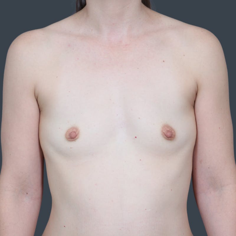 Breast Augmentation Before & After Gallery - Patient 241567 - Image 1