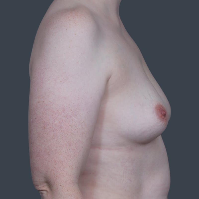 Breast Augmentation Before & After Gallery - Patient 307041 - Image 3