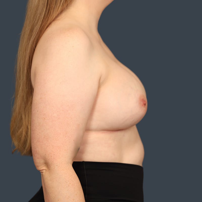 Breast Augmentation Before & After Gallery - Patient 272234 - Image 4